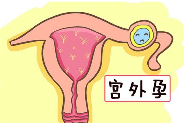 漳州助孕中介哪家好：试管婴儿中的宫外孕有哪些迹象？
